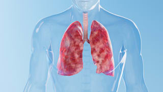 Fibrose: Symptome, Diagnose und Behandlung der Krankheit im Überblick