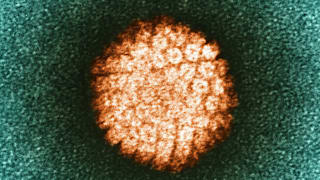 Feigwarzen: Symptome, Diagnose und Behandlung der Geschlechtskrankheit