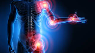 Rheuma: Symptome, Diagnose, Behandlung und Vorbeugung