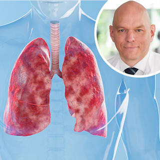 Experte zu Lungenerkrankung: „COPD ist eine Volkskrankheit“