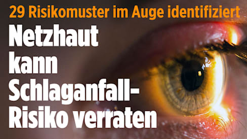 29 Muster in der Netzhaut deuten auf erhöhtes Schlaganfallrisiko hin