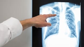 Tuberkulose: Symptome, Diagnose und Behandlung der Krankheit