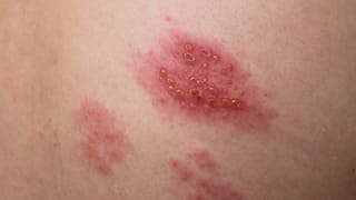 Gürtelrose: Symptome, Diagnose und Behandlung