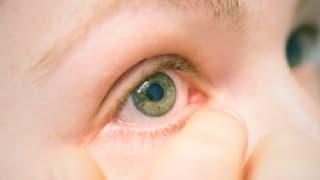 Bindehautentzündungen: Ursachen, Symptome und Behandlung